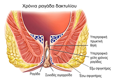 ΡΑΓΑΔΑ ΔΑΚΤΥΛΙΟΥ, ΤΙ ΕΙΝΑΙ ΚΑΙ ΠΩΣ ΑΝΤΙΜΕΤΩΠΙΖΕΤΑΙ;