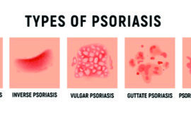 Τι να προσέχετε το καλοκαίρι αν έχετε ψωρίαση