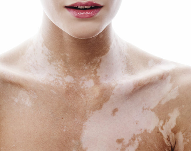 Λεύκη: Τι είναι, πώς ξεκινάει και τι μπορείτε να κάνετε – Περιορίζεται η εξάπλωση;