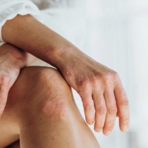 Η ψωρίαση δεν σταματά στο δέρμα